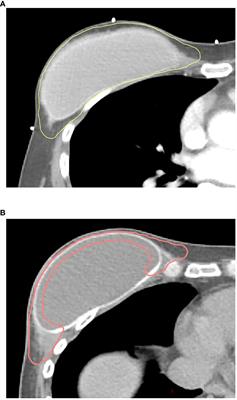 The impact of the new ESTRO-ACROP target volume delineation guidelines for postmastectomy radiotherapy after implant-based breast reconstruction on breast complications